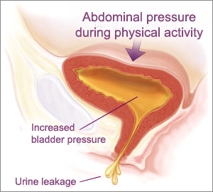 Bladder Surgery India Indian Med Guru