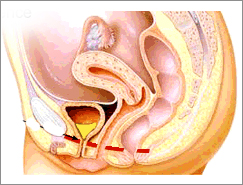Urine Incontinence Bladder Surgery India Indian Med Guru