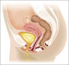 Urine Leakage Incontinence Bladder Surgery India Urine Leakage Incontinence Bladder Surgery India
