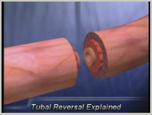 tubal-ligation-reversal1