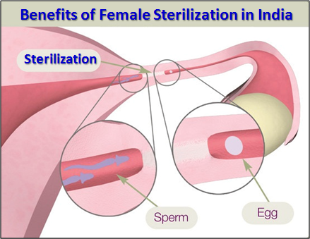 Female Sterilization In India