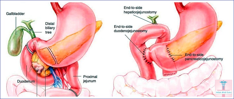Whipple Surgery Cost In India