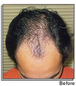 Hair Transplant Surgery in India
